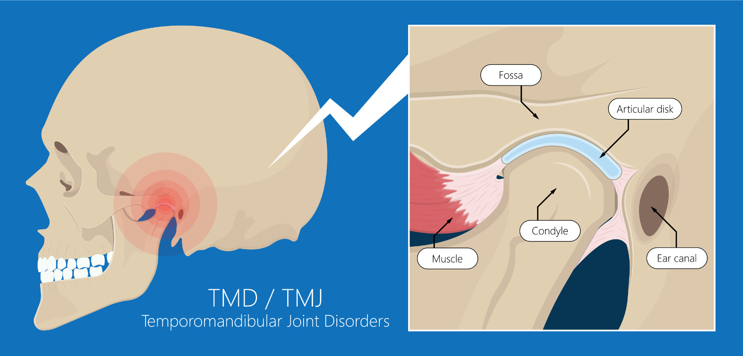 Temporomandibular Joint Dysfunction (TMJ Syndrome)